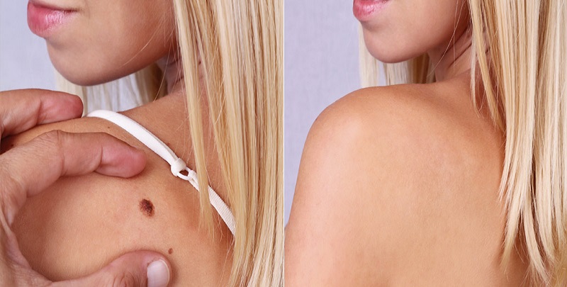 Боремся с папилломами с помощью лазера