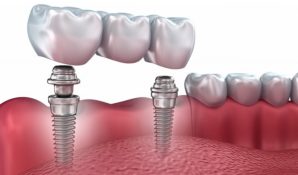 Сеть клиник «Зууб.рф» приглашает установить зубные импланты по акции
