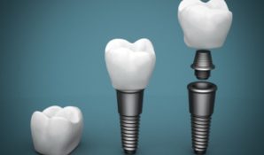 Имплантация «All-on-6» – один шаг к здоровой и красивой улыбке