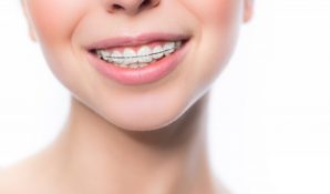 Установка брекетов со скидкой: стоматология «Зууб» проводит акцию