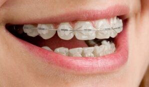 В клинике «Зууб» стартовала акция по установке керамических брекетов