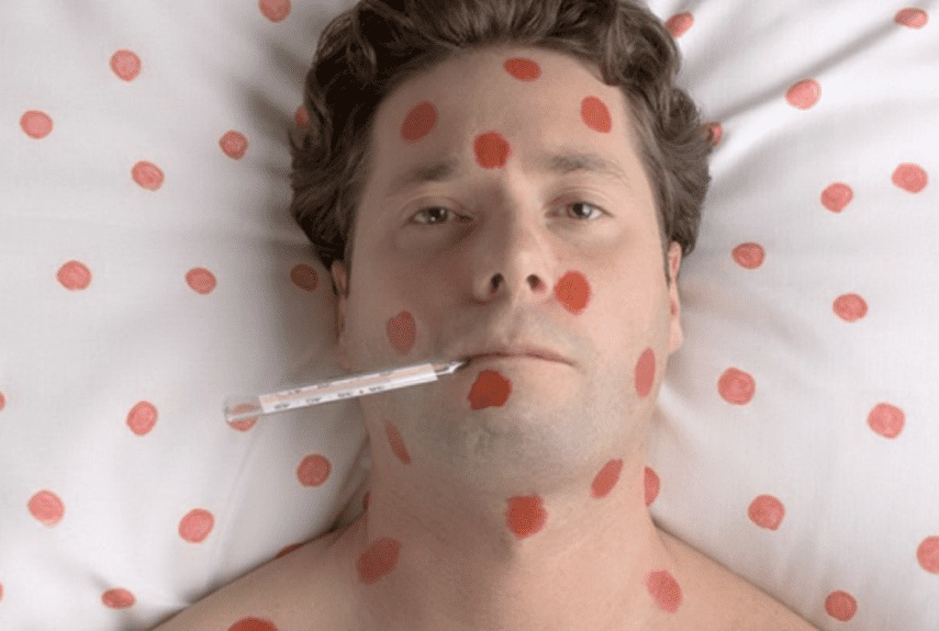 Менингит, энцефалит, пневмония: осложнения ветрянки. Тяжелые и атипичные формы инфекции